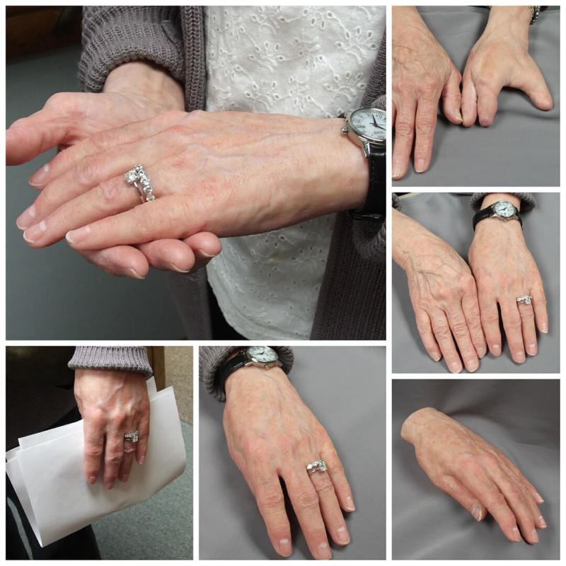 Finger Hand Photo Gallery Medical Art Prosthetics