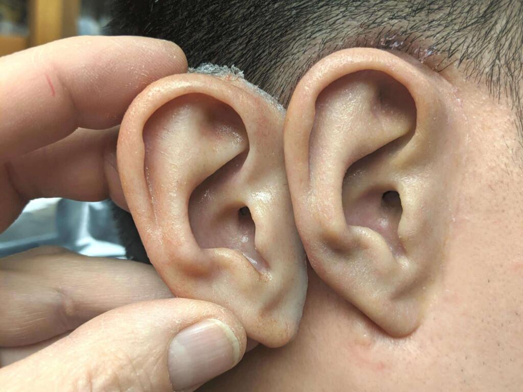 A person wearing a prosthetic ear and a hand holding a new ear replacement next to it.