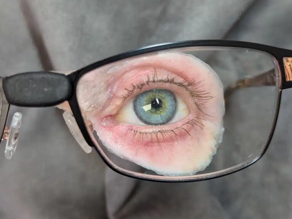 eye prosthesis