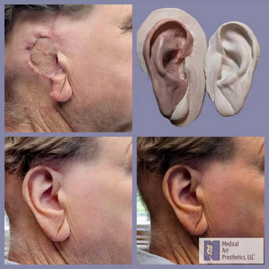 Photos of man wearing ear prosthesis and without the ear in place