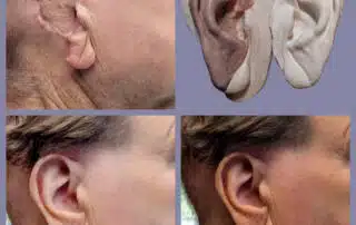 Photos of man wearing ear prosthesis and without the ear in place