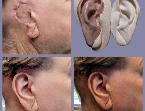 Wisconsin Anaplastologist Creates Prosthetic Ear in Madison