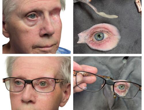 Surgeon and Anaplastologist Treat Cancer while Restoring Eye Anatomy with an Orbital Eye Prosthesis