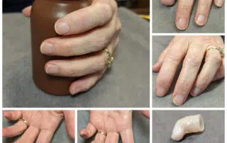 Images showing woman with and without her prosthetic fingertip on her amputated index finger.