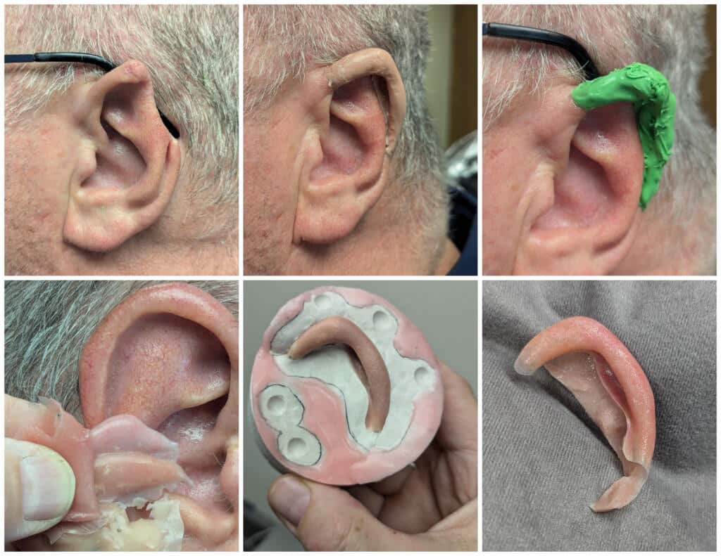 a collage of a man's ear damaged in accident