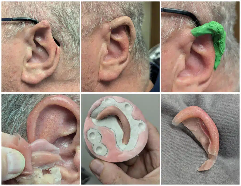 a collage of a man's ear damaged in accident