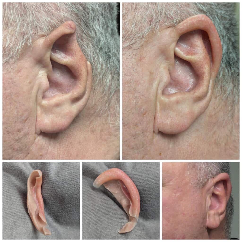 a close up of a man's ear that has a piece missing from the rim of his ear