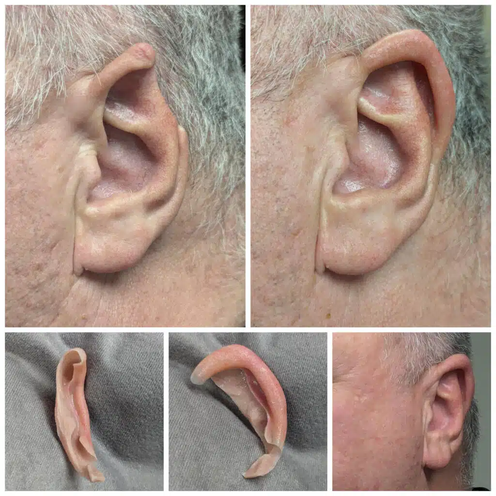 a close up of a man's ear that has a piece missing from the rim of his ear