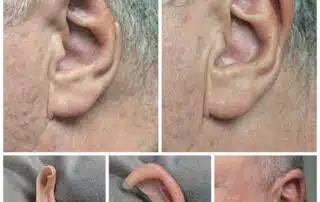 a close up of a man's ear that has a piece missing from the rim of his ear