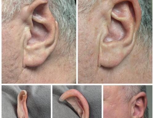 Prosthetic ear restores missing part of man’s ear