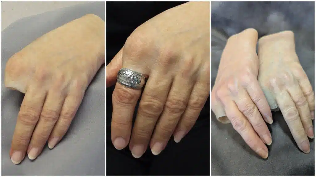 Set of 3 photos showing a partial hand prosthesis