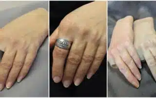 Set of 3 photos showing a partial hand prosthesis