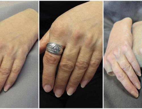 Partial Hand Prosthesis For Loyal Amputee 12 Years