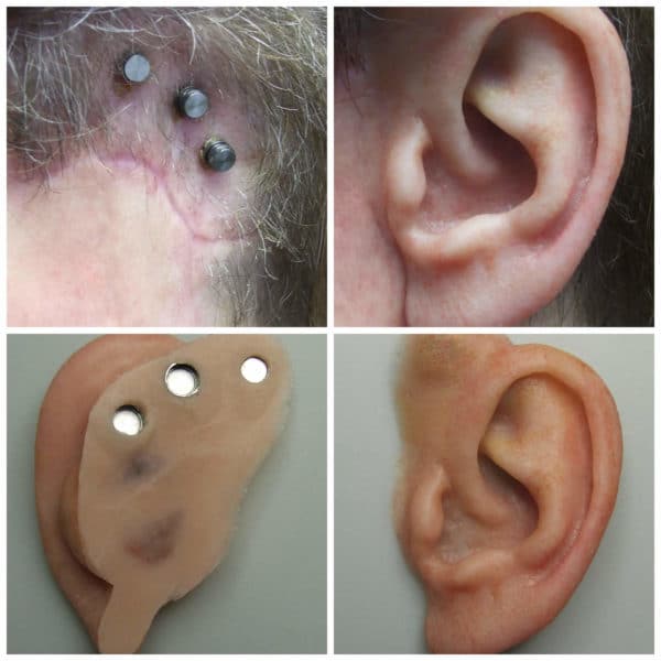 Auricular Photo Gallery Medical Art Prosthetics