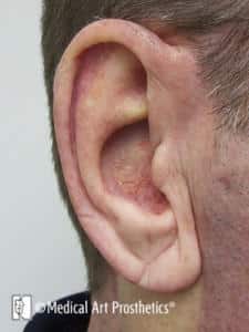 A man 's ear with an area of redness and inflammation.