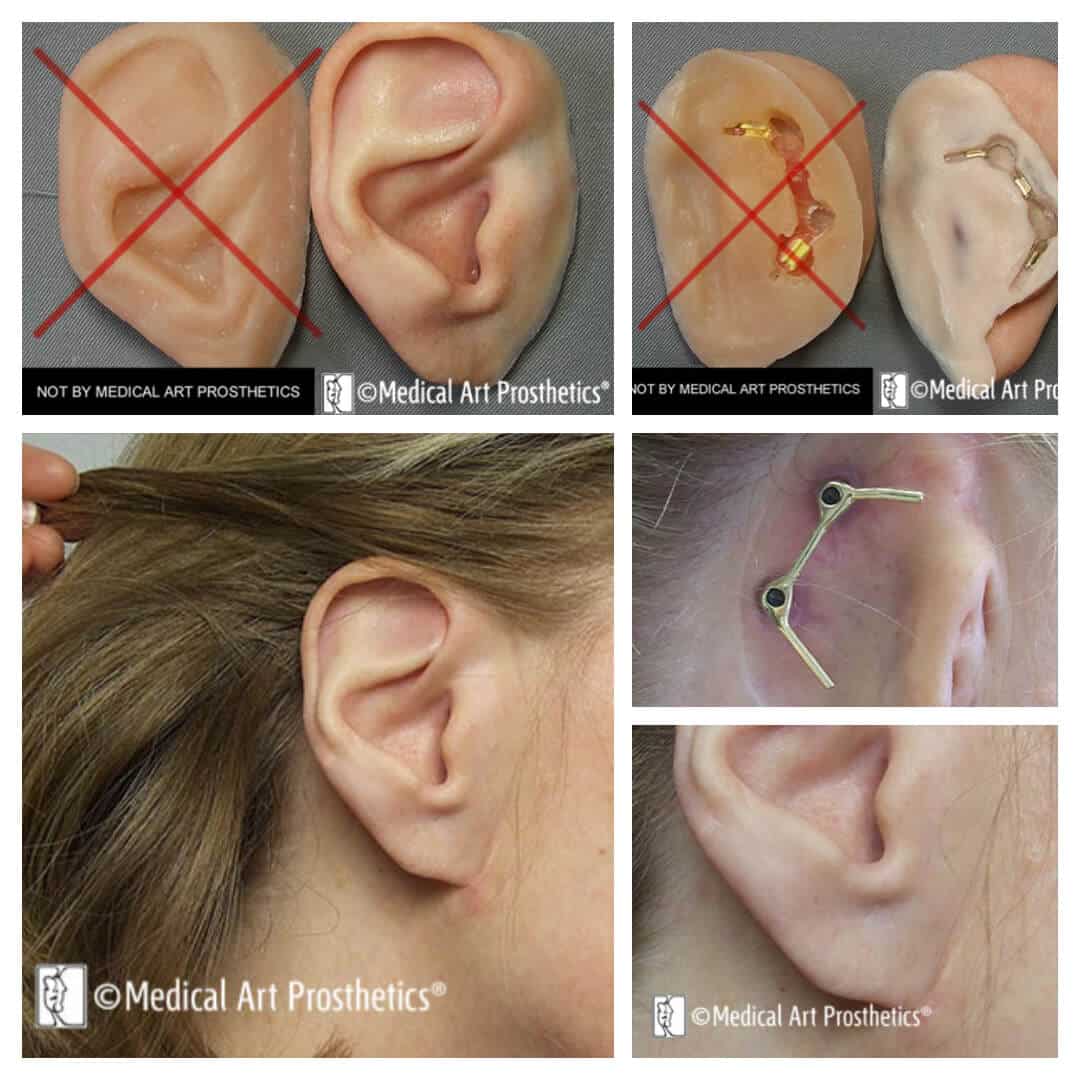 images of a poor ear prosthesis and our new bar clip retained ear prosthesis replacement
