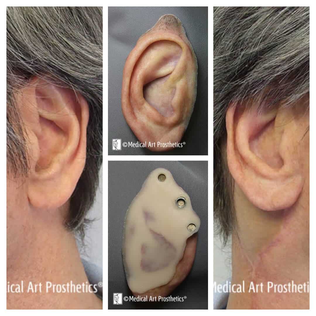 images of a male wearing a magnet-retained prosthetic ear with longer hair to conceal margins.