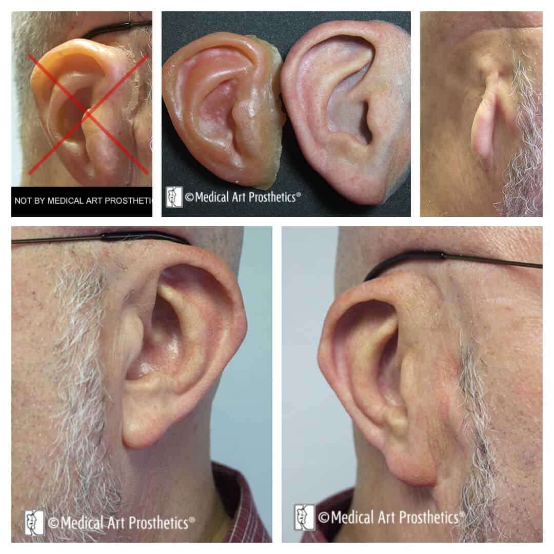 images of an older microtia customer with obsolete prostheses and our new replacement ear prosthesis in place