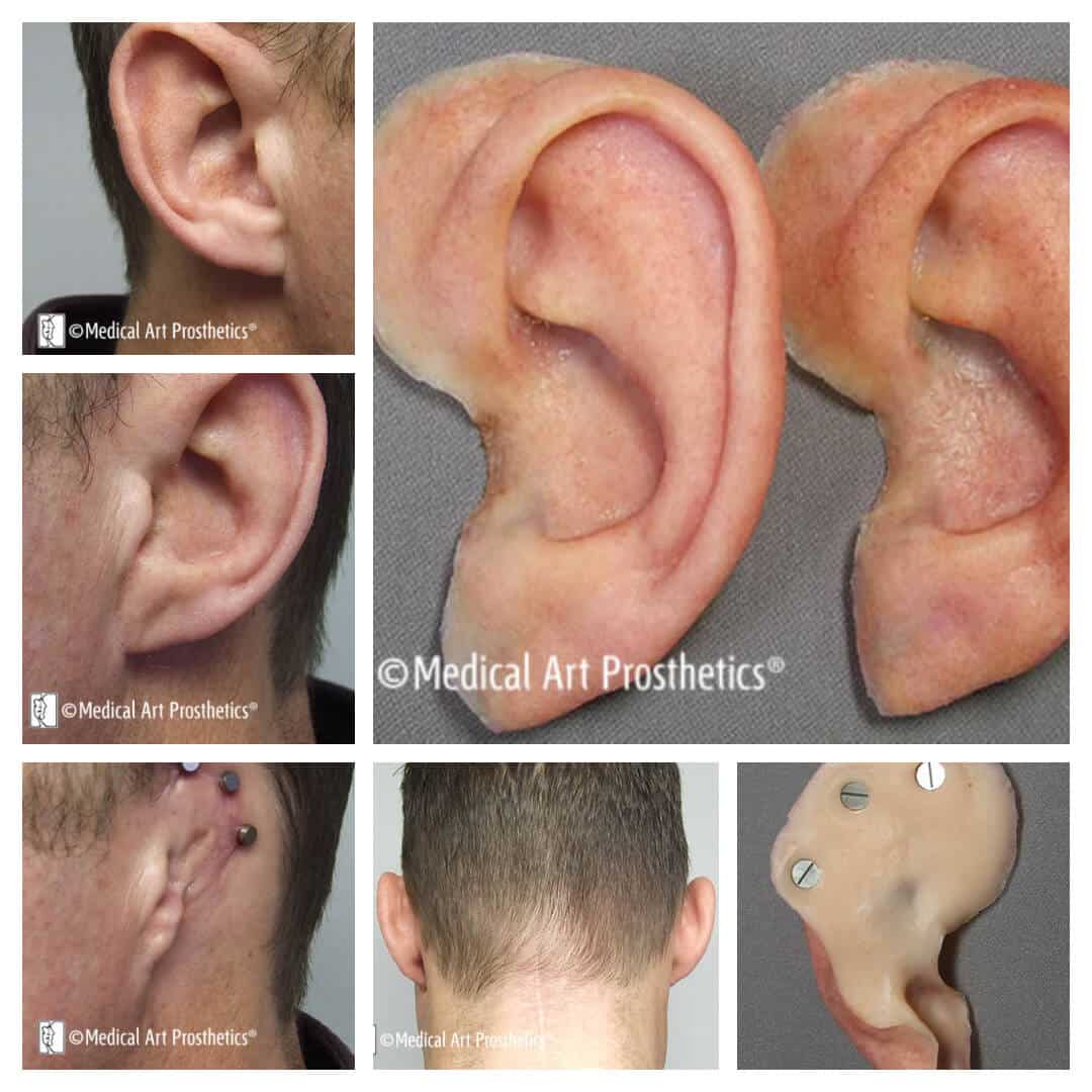 Images of a young man with short hair style wearing a magnet retained ear prosthesis from the front, back, and side veiws
