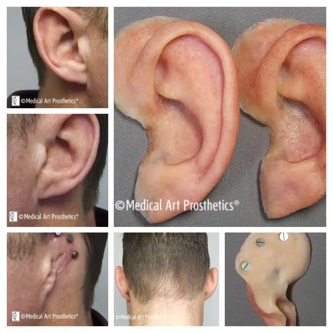 Images of a young man with short hair style wearing a magnet retained ear prosthesis from the front, back, and side veiws