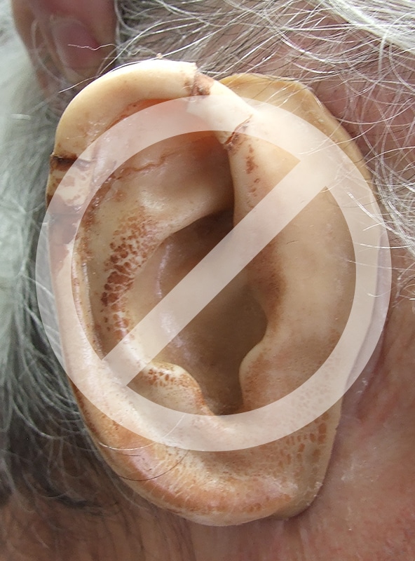 Photo of cracked ear prosthesis made of poor material on patient