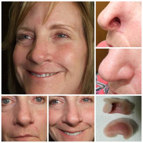 Nasal Photo Gallery Medical Art Prosthetics