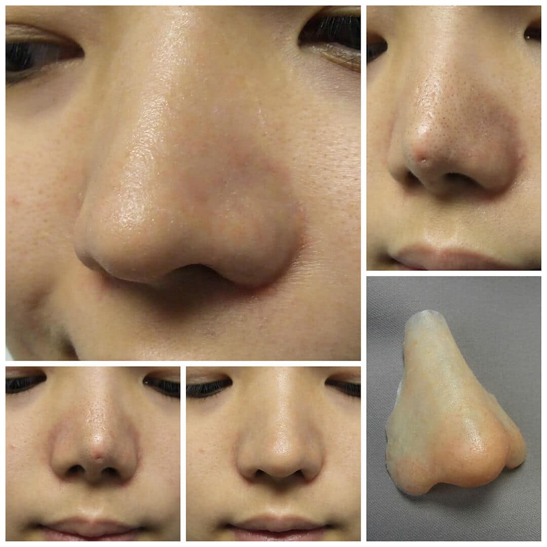 whoville nose prosthetic