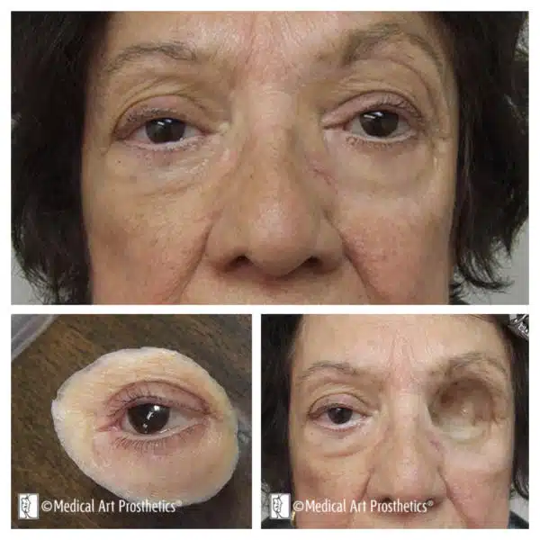 A woman with a patch on her eye and an area of the lower eyelid.