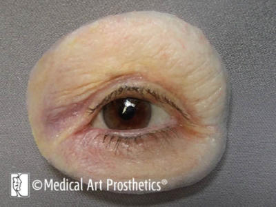 Orbital - Eye Prosthetics – Medical Art Prosthetics