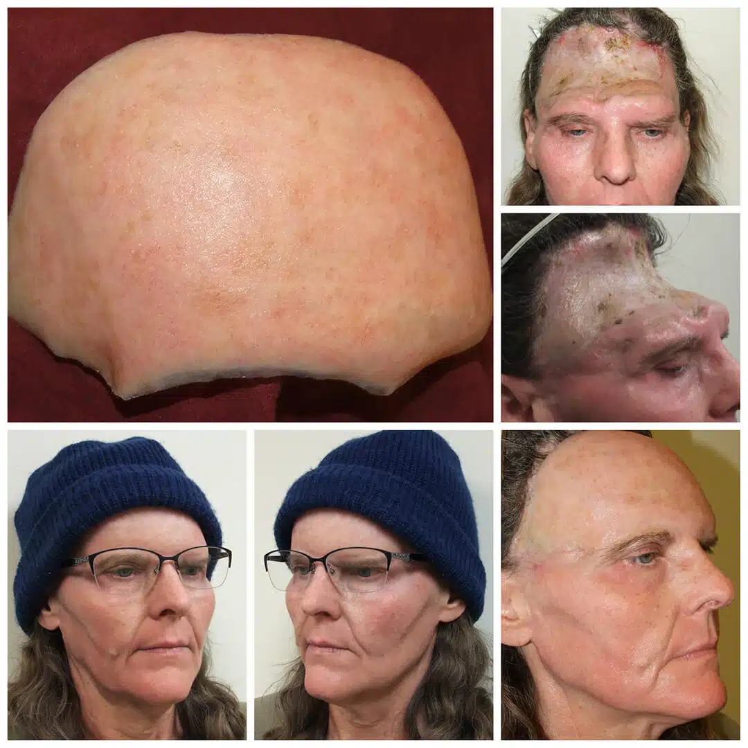 A woman with various stages of hair loss.