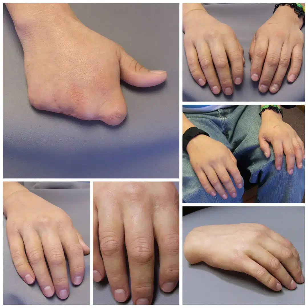 Silicone Finger Prosthetics