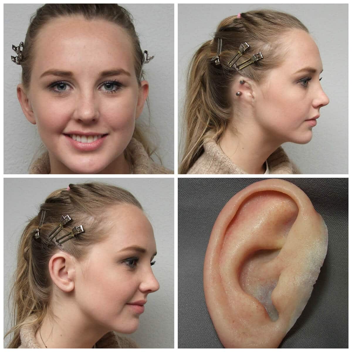 Images of young woman withot her ear prosthesis showing her abutments, one showing her prosthesis, and a photo of her smiling with the ear atteached fromfront and the side view.