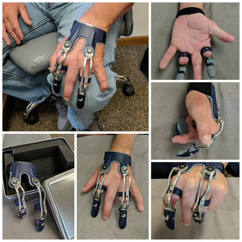 Prosthetic fingers on a patients hand