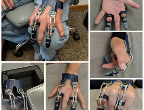 Prosthetic Fingers Assist Amputee 7 Days A Week