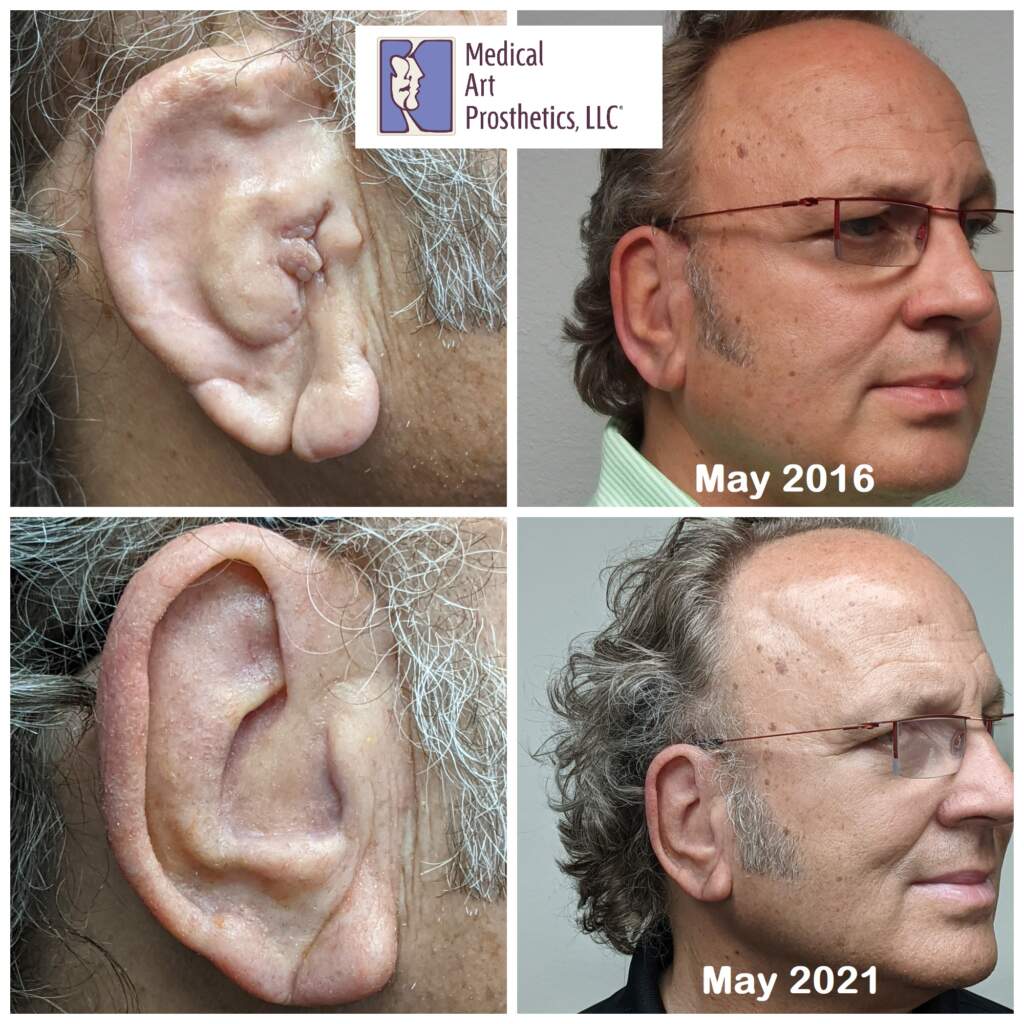 A man with glasses and no shirt is wearing an ear prosthesis.