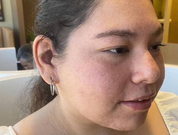 Young woman wearing her new ear prosthesis with her favorite earring in the earlobe