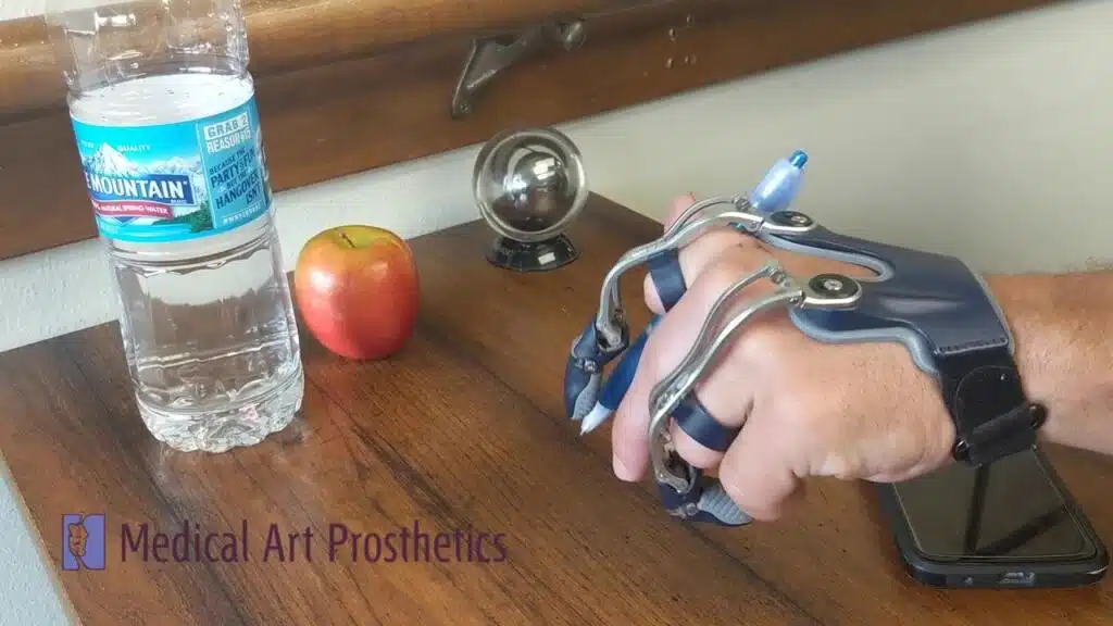 Hand prosthetic using pen and phone.