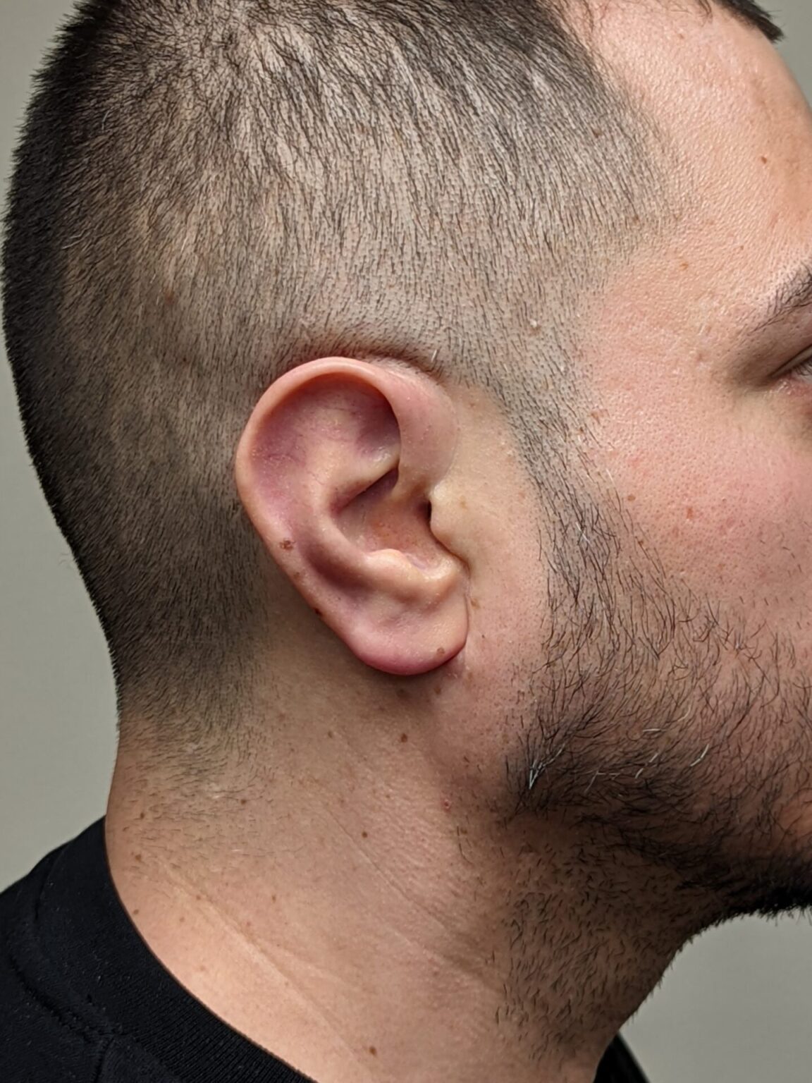 10 Man With Magnetic Ear Prosthesis