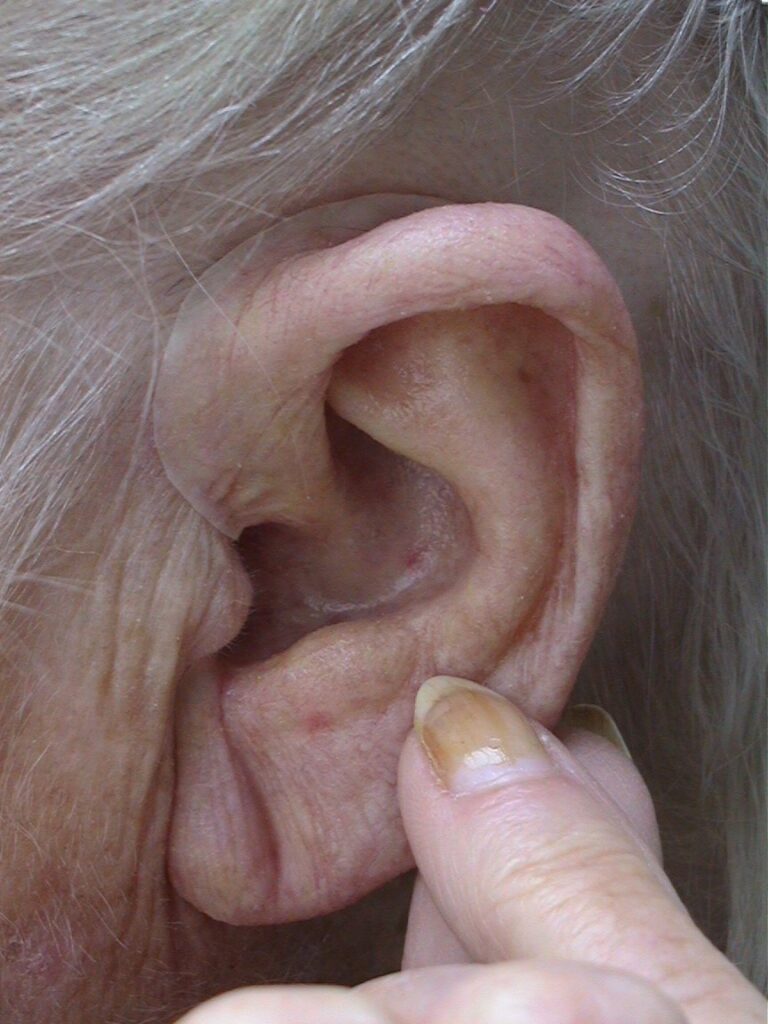 silicone ear prosthesis being positioned by woman