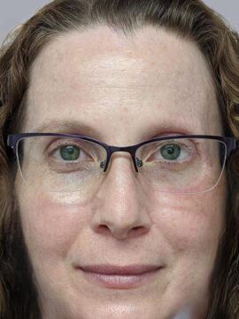 Final orbital prosthesis result