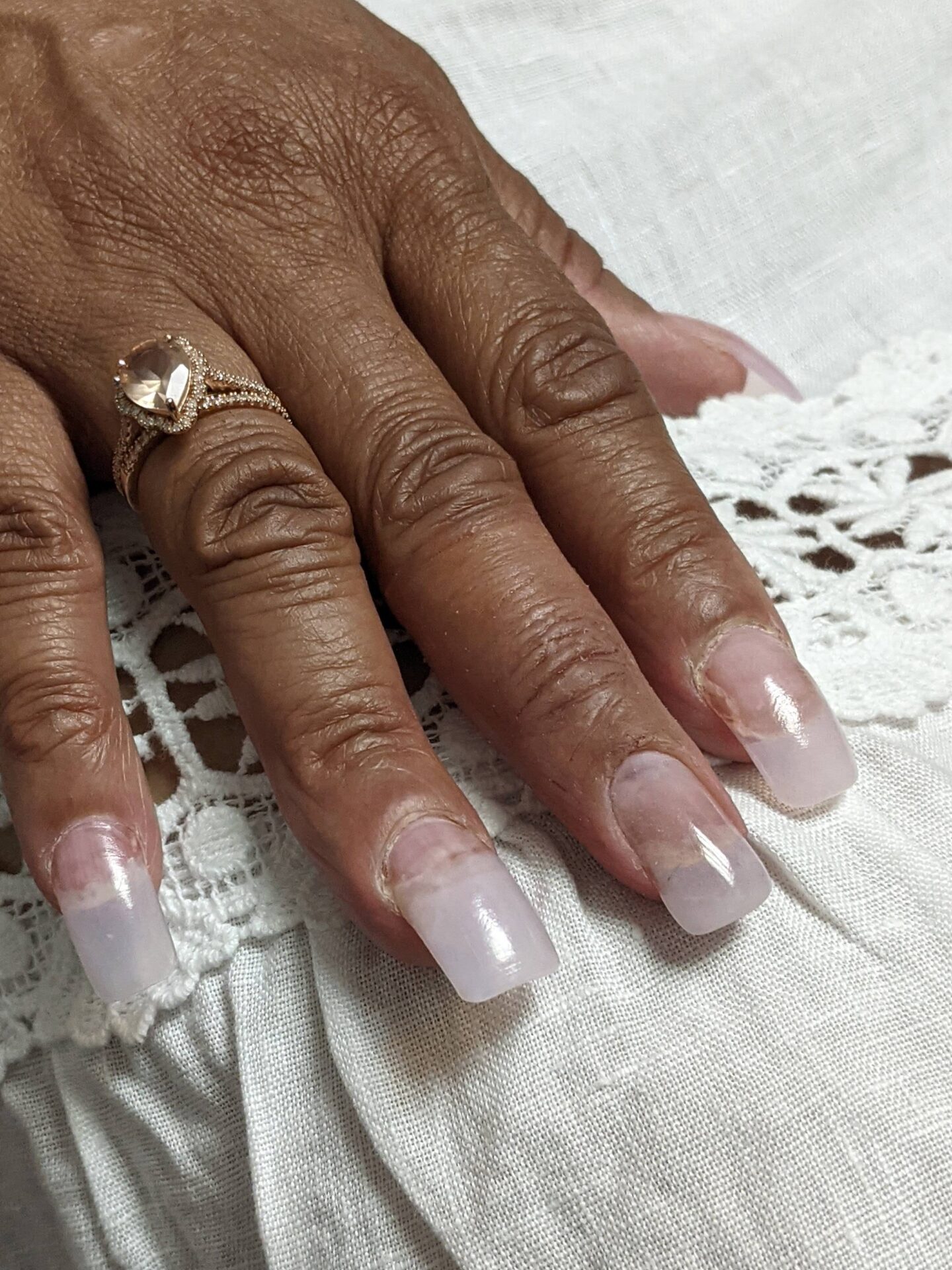 Hand with prosthetic fingers