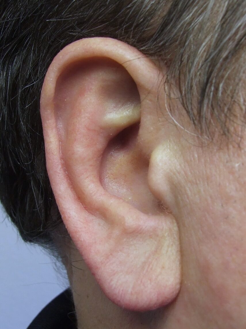 man wearing magnetic ear prosthesis attached to bone-anchored implants