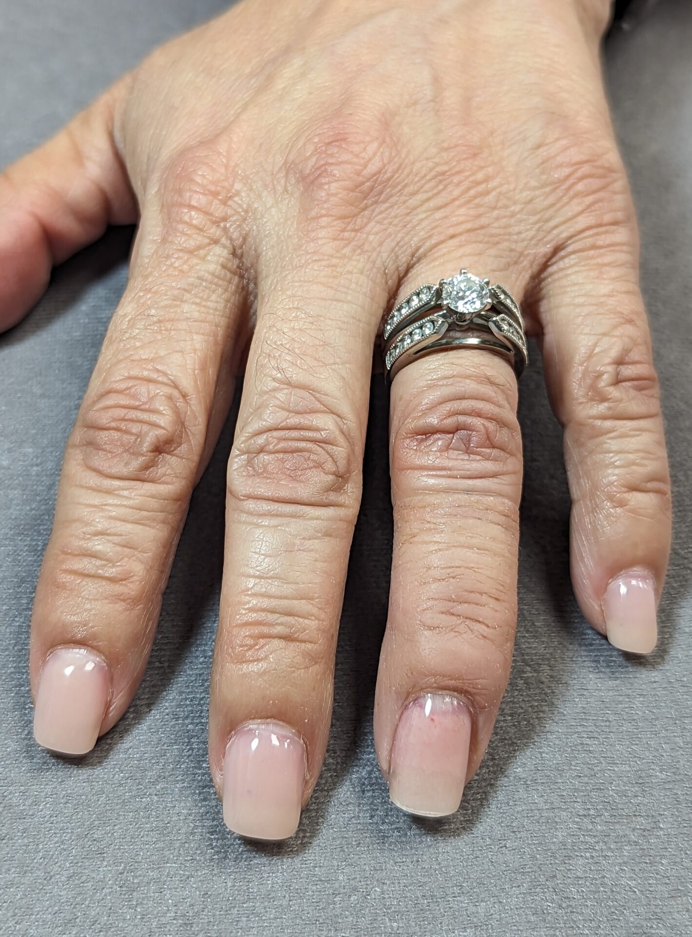 Prosthetic fingers with ring
