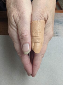 wax prosthesis prototype on patient