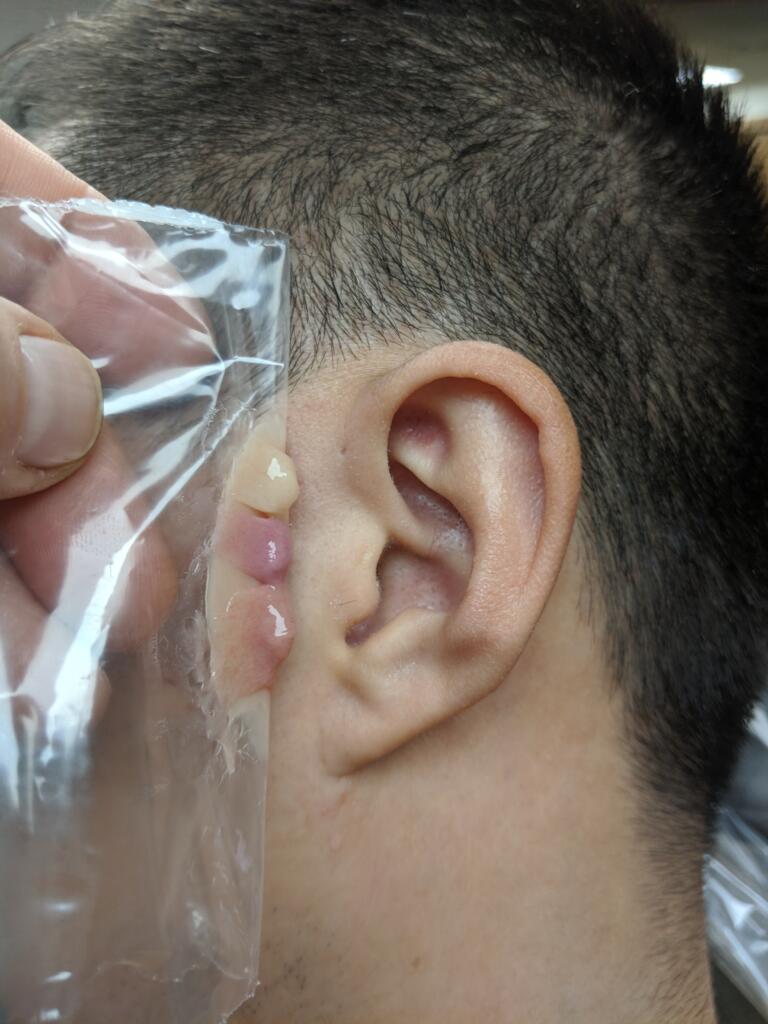 A person 's ear with an injury on it.