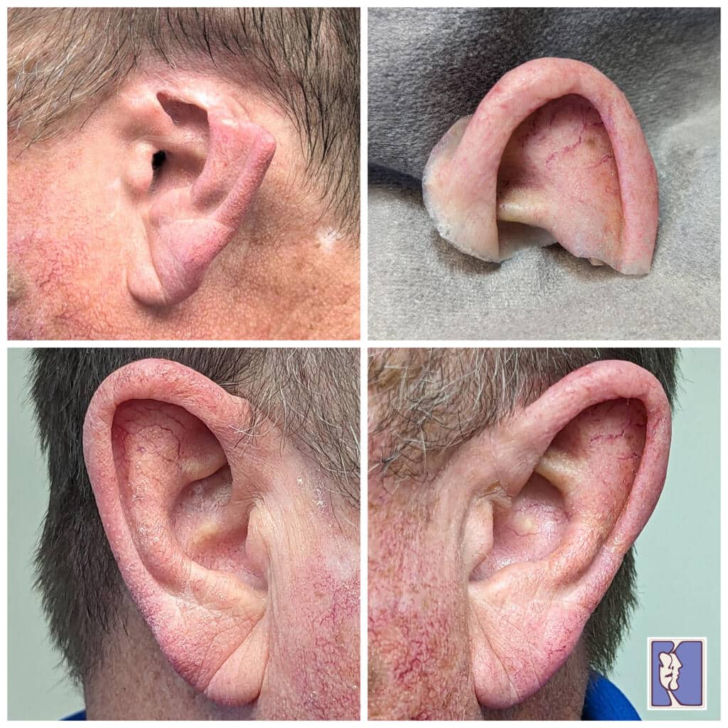 A person 's ear with an injury on it.