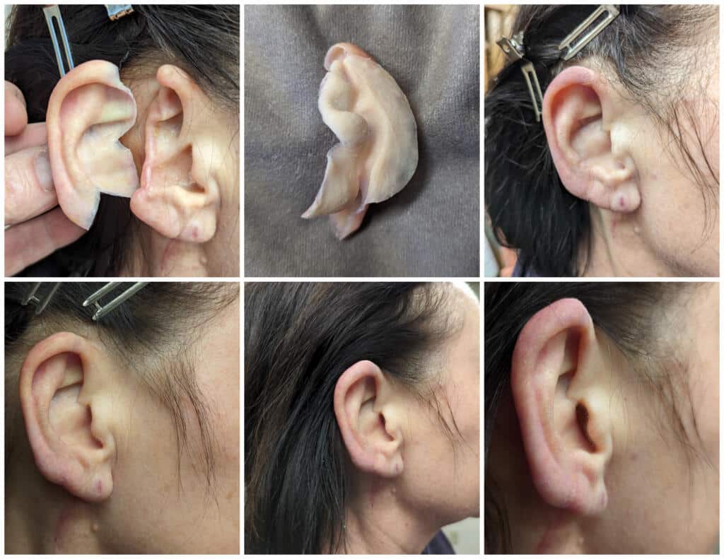 Ear prosthetic series showing the ear prosthesis next to ear defect and in place restoring appearance to normal