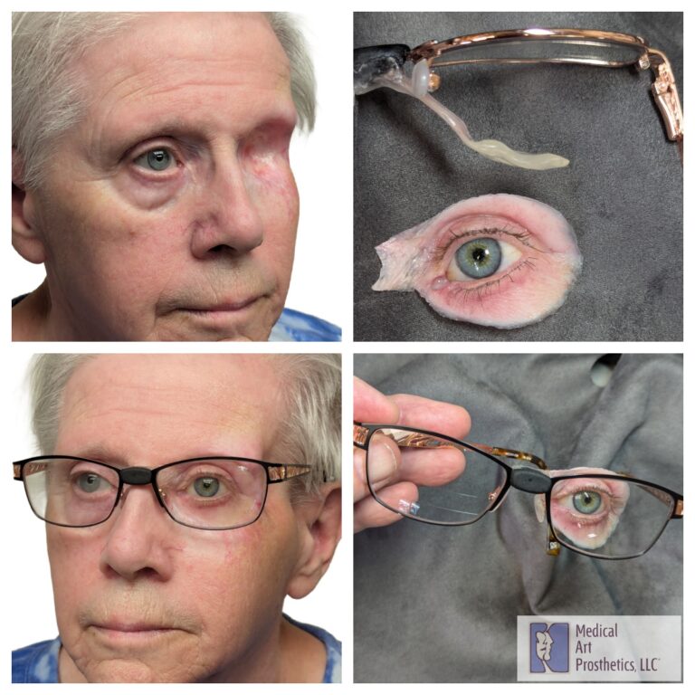 a collage of a woman with eye disease