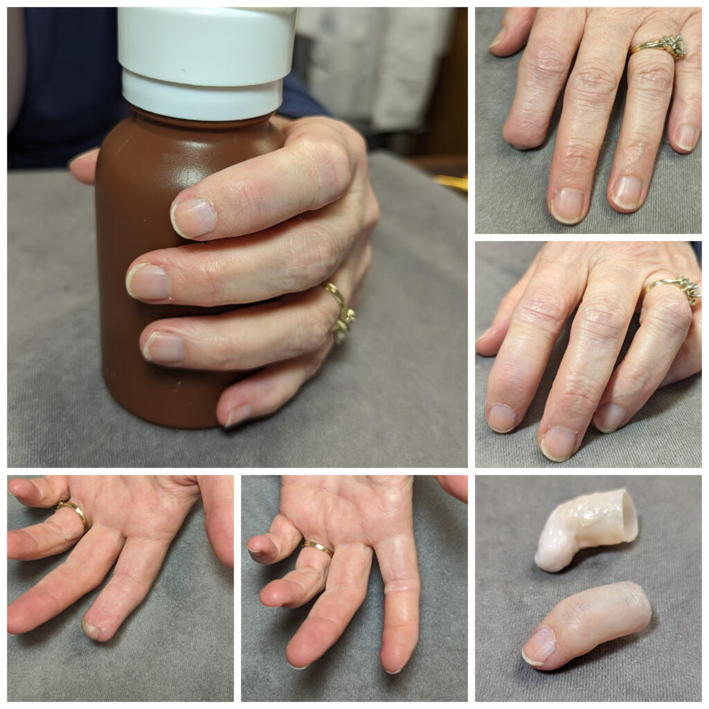 Images showing woman with and without her prosthetic fingertip on her amputated index finger.