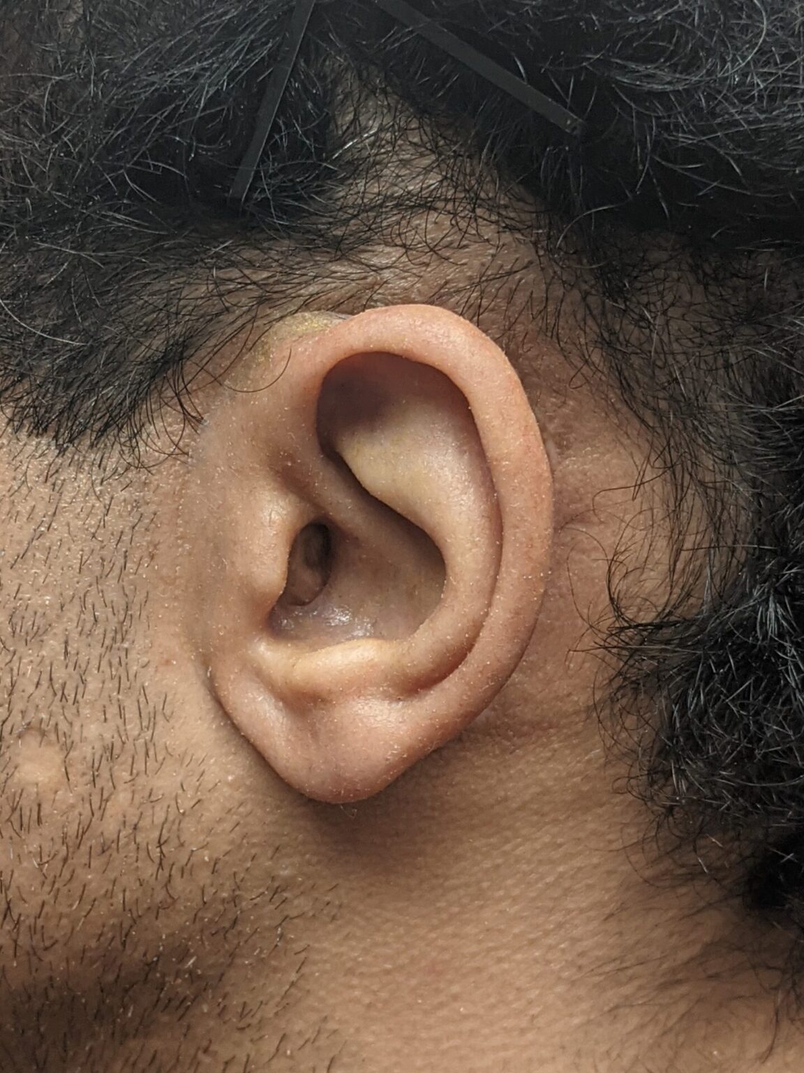 custom ear prosthetics for dark skin toned African American